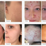 Acaba con el acné en Nahda con nuestros productos de cuidado facial