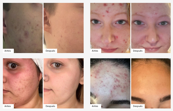 Acaba con el acné en Nahda con nuestros productos de cuidado facial