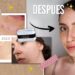 Adiós al acné con nuestra rutina de skincare