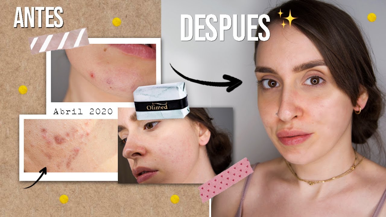 Adiós al acné con nuestra rutina de skincare