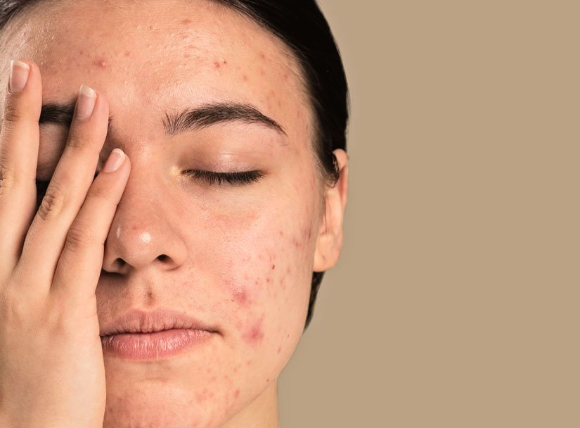 Descubre el mejor maquillaje para Belleza con acné – Oculta imperfecciones y luce radiante.