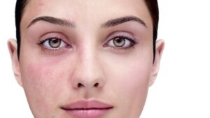 Descubre el mejor maquillaje para rosácea: lucir una Belleza impecable nunca fue tan fácil.
