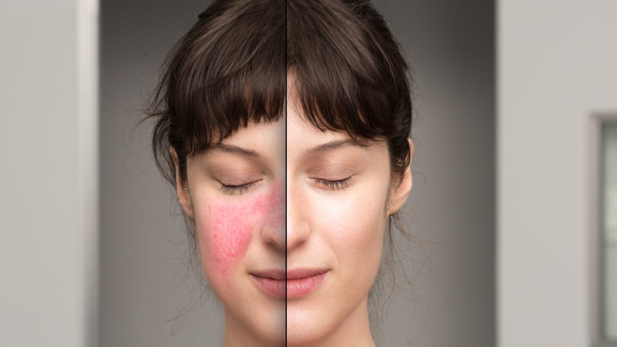 Descubre el mejor maquillaje para tratar y disimular la rosácea.