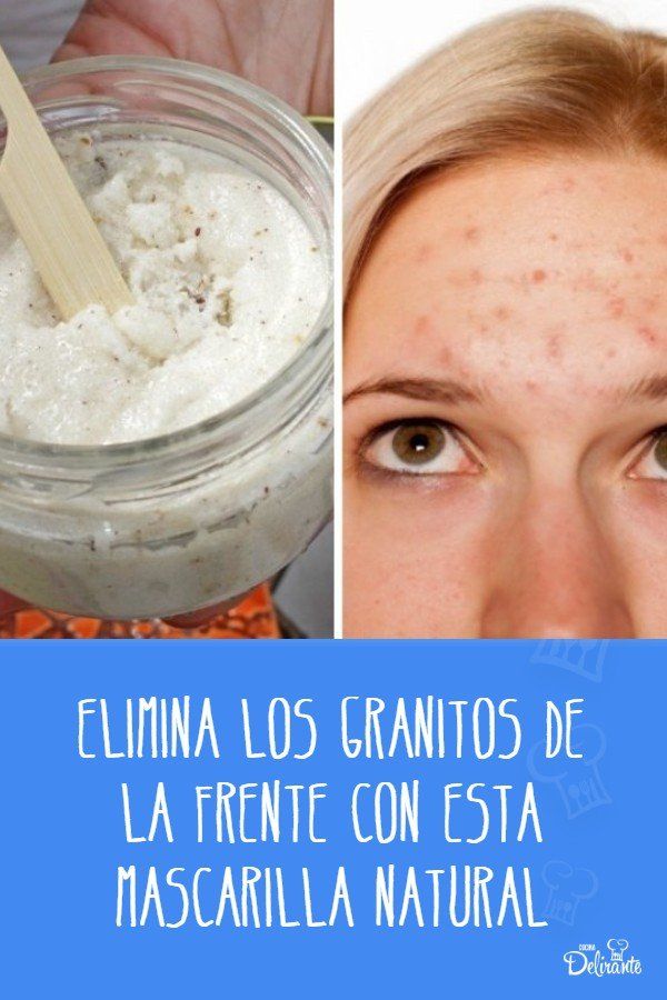 Consejos de cuidado de piel para el acné: ¡adiós granitos!