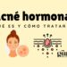 Consejos de skincare para combatir el acné