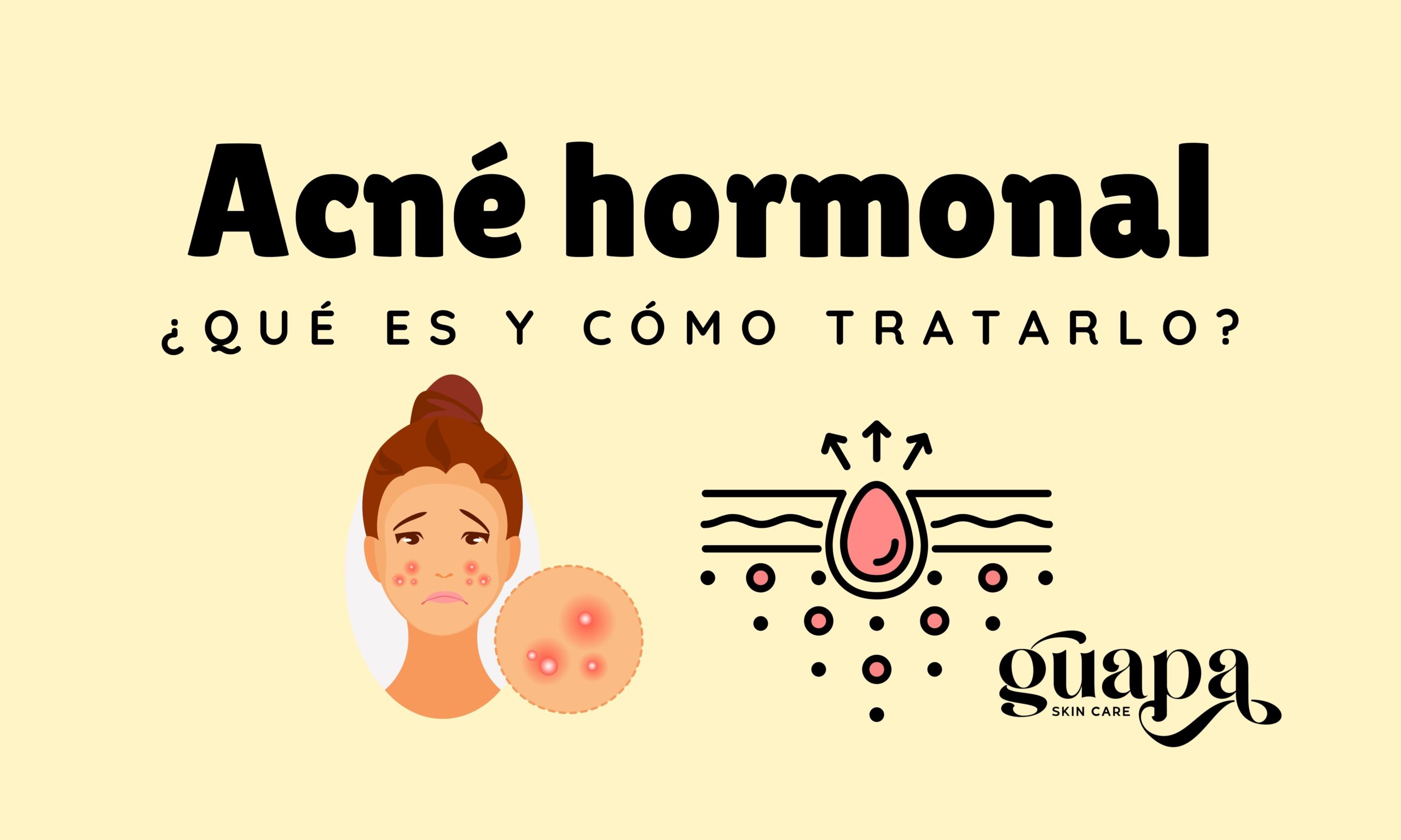 Consejos de skincare para combatir el acné
