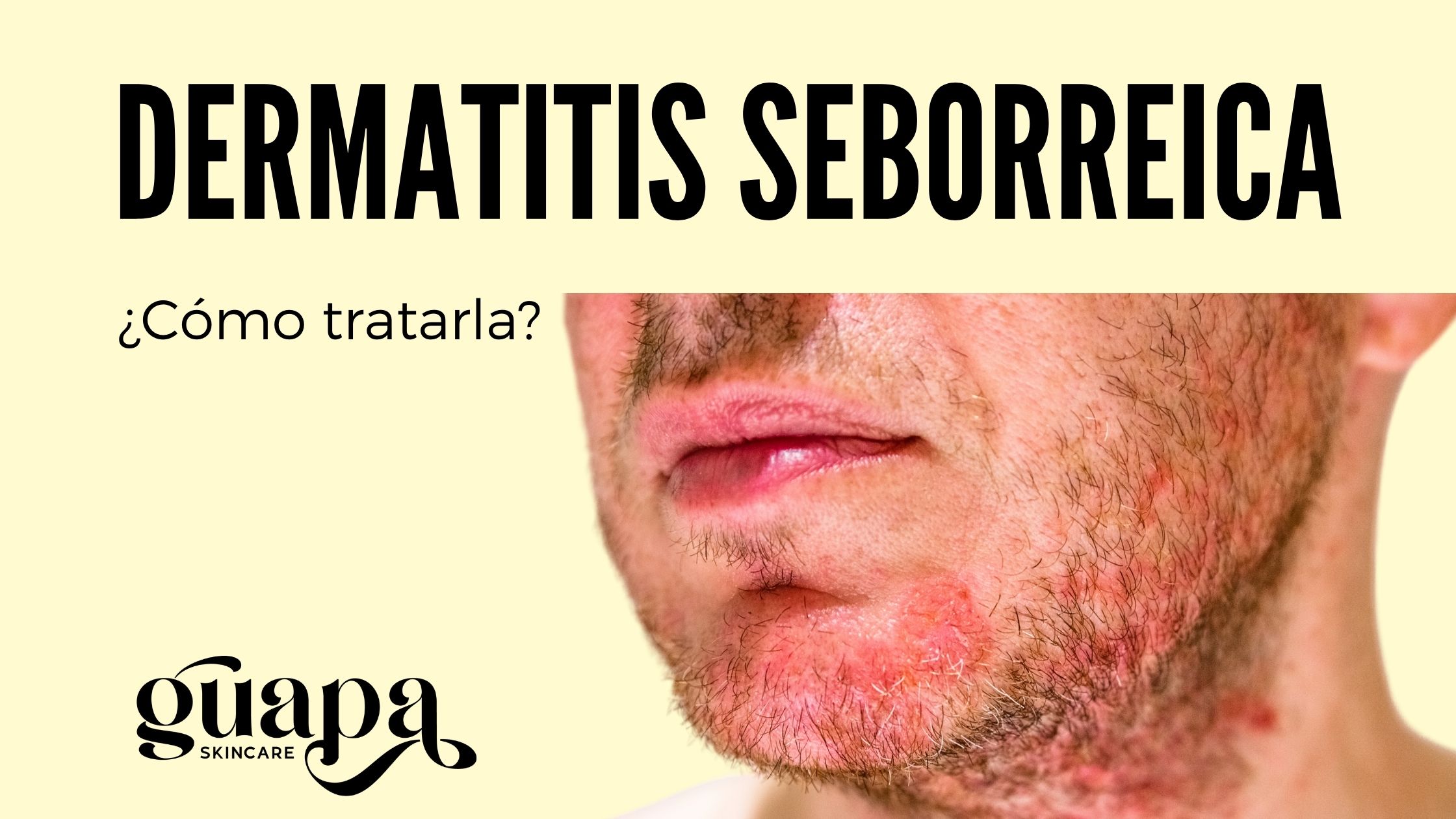 Controla la dermatitis seborreica con nuestra rutina de skincare