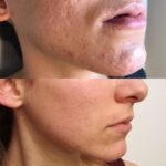 Cuida tu piel con acné rosácea: consejos efectivos