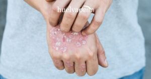 Cuida tu piel con psoriasis: consejos de skincare