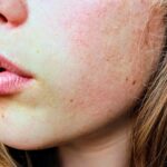Cuida tu piel mixta con acné: consejos de skincare