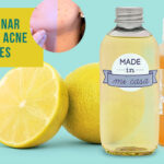 Elimina cicatrices de acné con ingredientes naturales