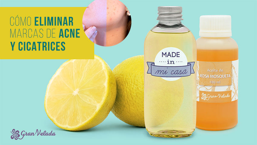 Elimina cicatrices de acné con ingredientes naturales