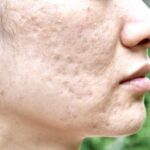 Elimina cicatrices de acné con los mejores productos de cuidado facial