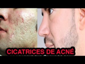 Elimina cicatrices de acné con nuestra rutina de cuidado de la piel