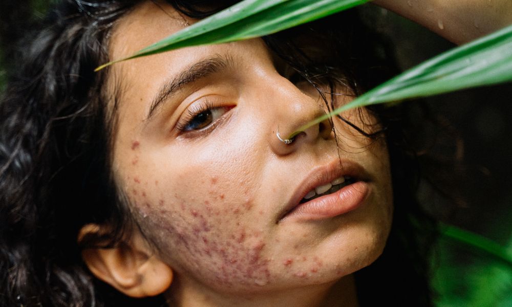 Elimina el acné con nuestra rutina de cuidado en 12h en Francia