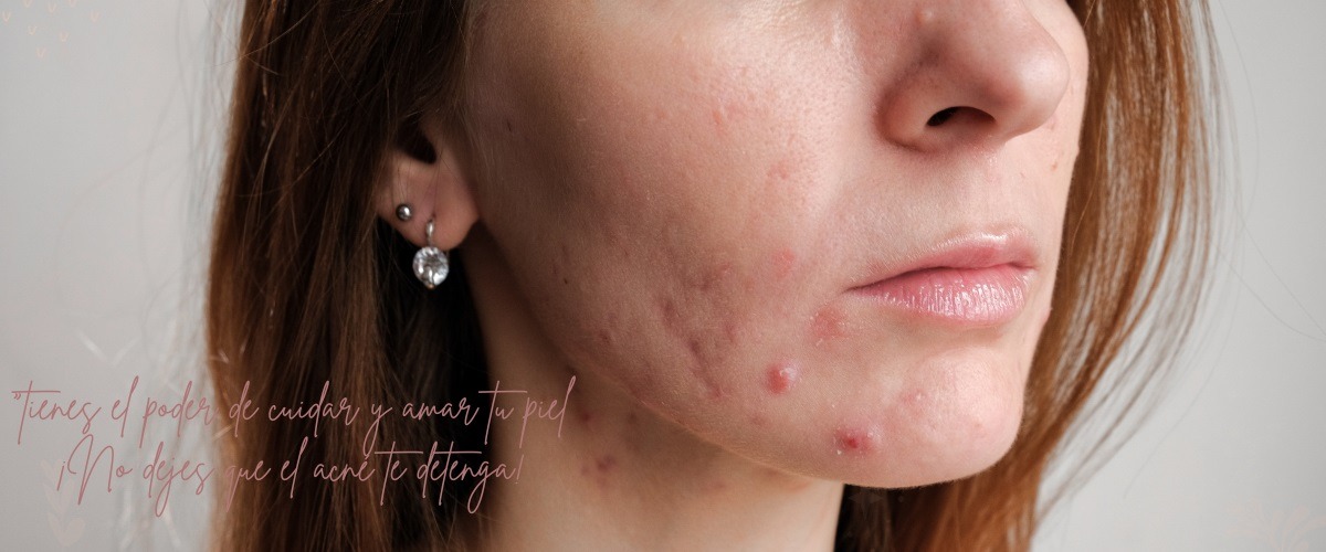 Elimina el acné hormonal con la rutina de cuidado de piel coreana