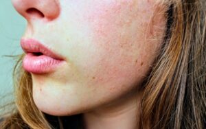 Elimina el exceso de grasa con nuestra rutina de skincare