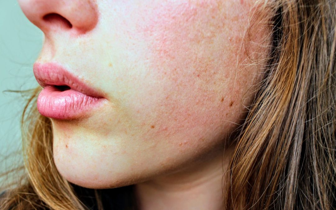 Elimina el exceso de grasa con nuestra rutina de skincare