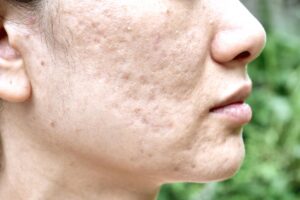 Elimina las cicatrices del acné con nuestra rutina de skincare