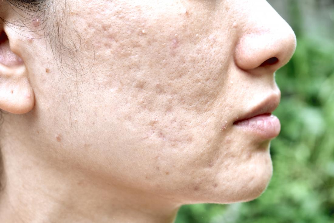 Elimina las cicatrices del acné con nuestra rutina de skincare