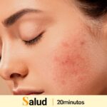 Elimina los granos con nuestra rutina de skincare
