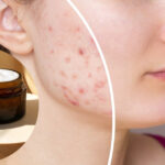 Elimina manchas de acné con nuestro skincare