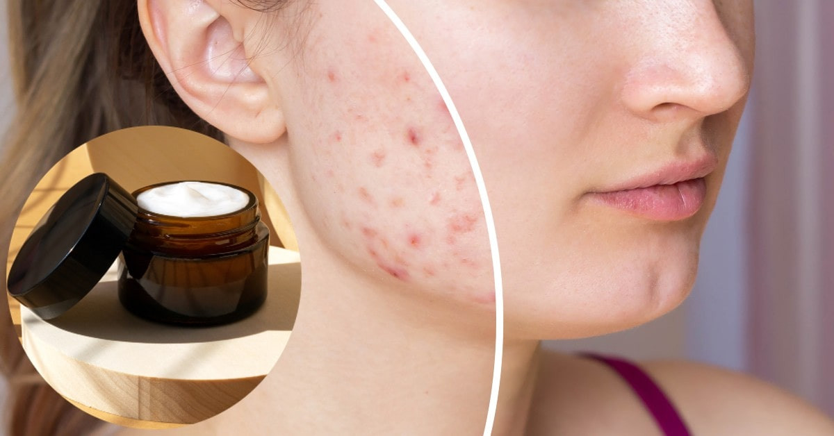 Elimina manchas de acné con nuestro skincare