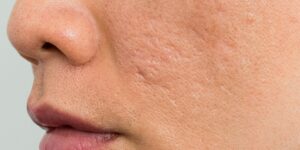 Elimina marcas de acné con nuestros productos de cuidado facial
