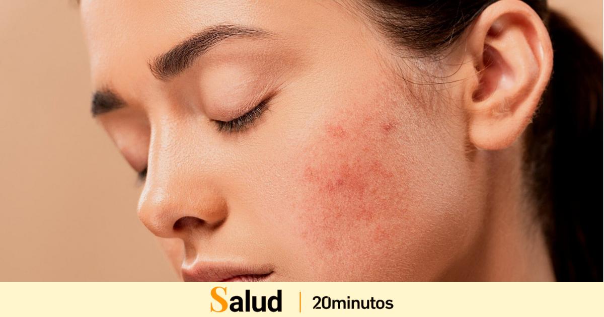 Elimina tus granos con nuestra rutina de skincare