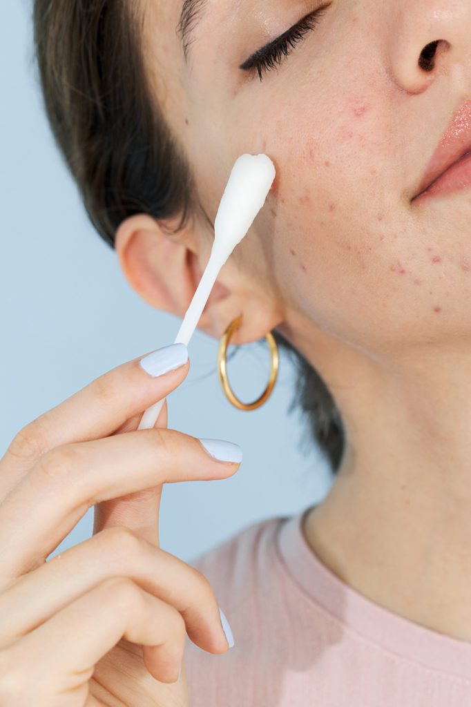 La mejor skincare coreana para el acné: ¡adiós a los granitos!