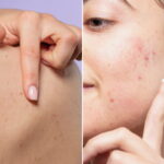 ¿Los productos de cuidado facial causan acné? Descubre la verdad