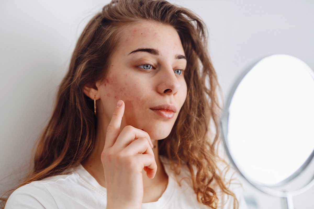 Opiniones expertas en cuidado de piel para el acné