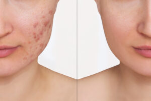 Rutina de cuidado facial para pieles acneicas: consejos y productos recomendados