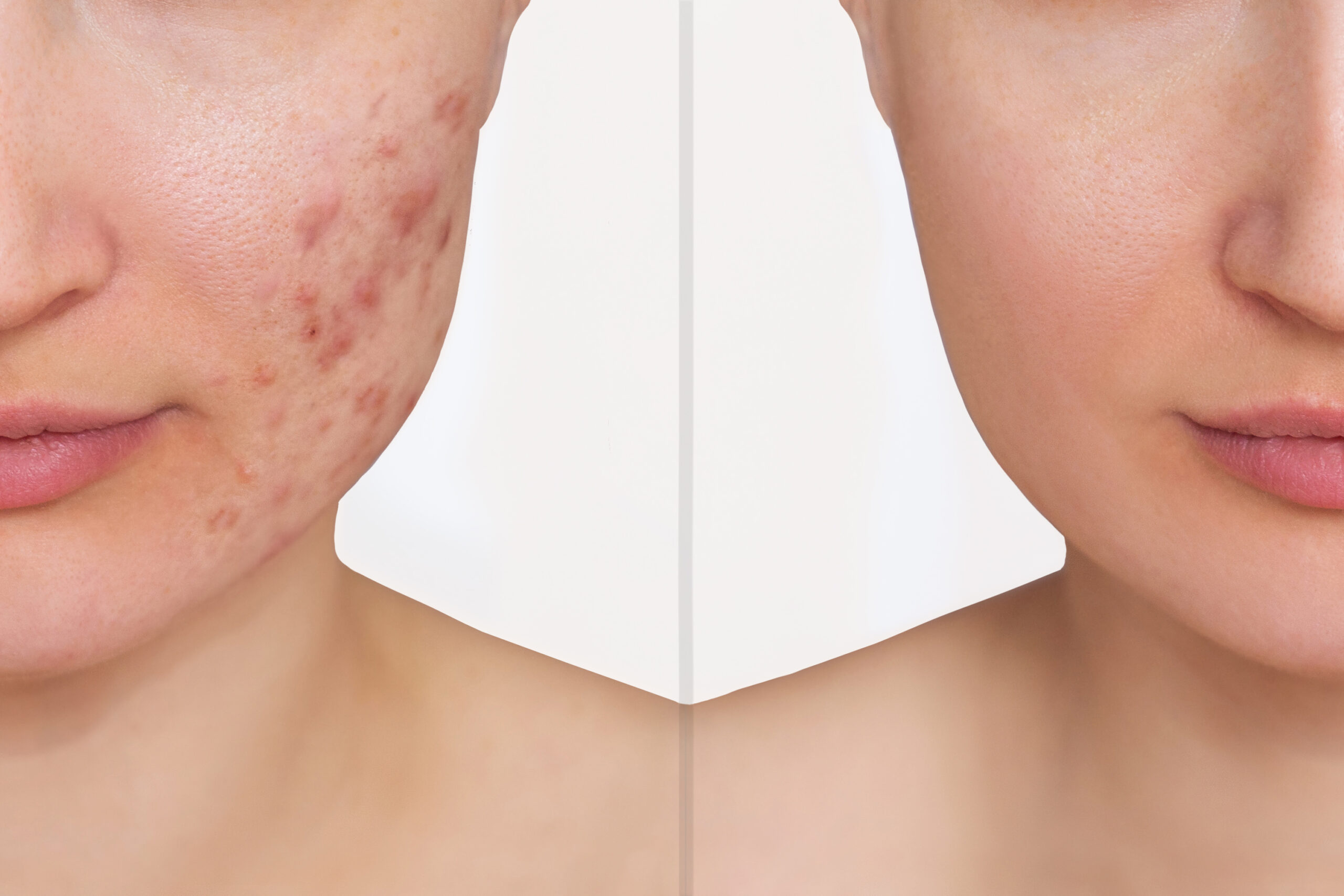 Rutina de cuidado facial para pieles acneicas: consejos y productos recomendados