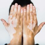 Consejos esenciales para el cuidado de la piel en pacientes con vitiligo