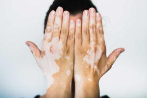 Consejos esenciales para el cuidado de la piel en pacientes con vitiligo