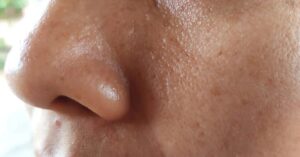 Consejos para el cuidado de la piel grasa con poros abiertos: mantén tu piel fresca y saludable.