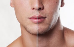 Consejos de cuidado de la piel grasa para hombres: mantén tu rostro fresco y sin brillo.