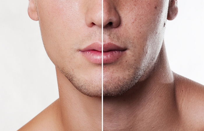 Consejos de cuidado de la piel grasa para hombres: mantén tu rostro fresco y sin brillo.