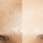 Consejos naturales para el cuidado de pieles grasas: ¡adiós al brillo excesivo!
