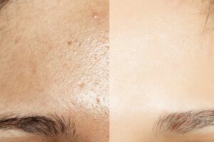 Consejos naturales para el cuidado de pieles grasas: ¡adiós al brillo excesivo!