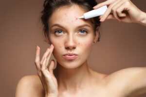 Consejos efectivos para el cuidado de la piel grasa y con acné: ¡Elimina el brillo y el acné de tu piel hoy!
