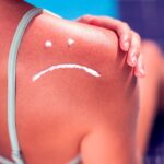 Consejos para cuidar y aliviar la piel quemada por el sol de manera efectiva