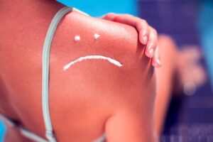 Consejos efectivos para cuidar la piel quemada y acelerar su recuperación