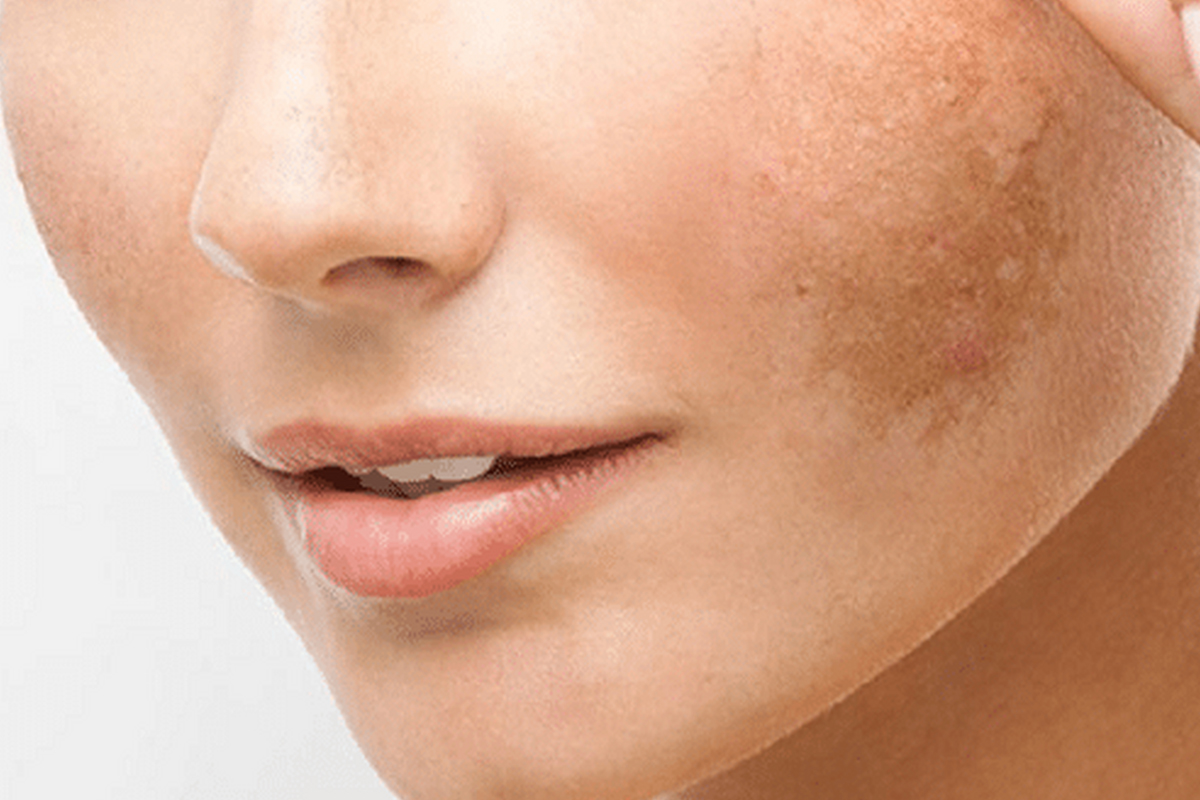 Elimina las manchas de tu piel con esta efectiva rutina de skincare