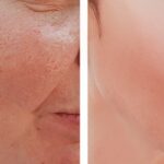Redescubre una piel radiante: Skincare para poros abiertos