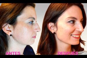 Descubre el rejuvenecimiento facial con maquillaje de ácido hialurónico