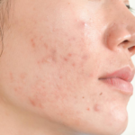 Rutina de cuidado para acné hormonal en Reddit