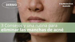 Rutina de cuidado para el acné fúngico: ¡adiós a las imperfecciones!