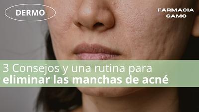 Rutina de cuidado para el acné fúngico: ¡adiós a las imperfecciones!